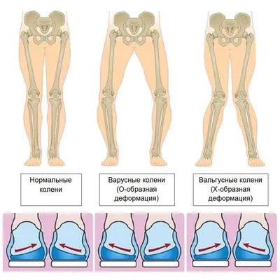 Варусная и вальгусная деформация — лечение в Ростове-на-Дону | Цены и отзывы