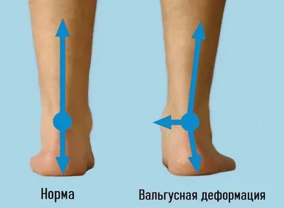 🦶Вальгусная деформация стопы у детей встречается очень часто! При вальгусе  стопа заваливается вовнутрь и колени принимают Х-образную… | Instagram