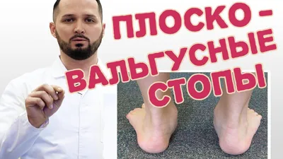 Вальгус у детей (вальгусная деформация стопы) - причины, симптомы,  диагностика, лечение