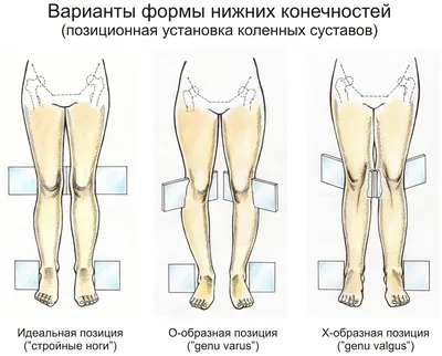 Вальгусная деформация стоп | Статьи интернет-магазина ORTHOBOOM