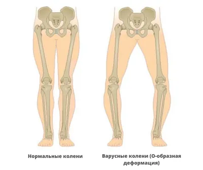 Вальгус (Valgus) | Ортофит