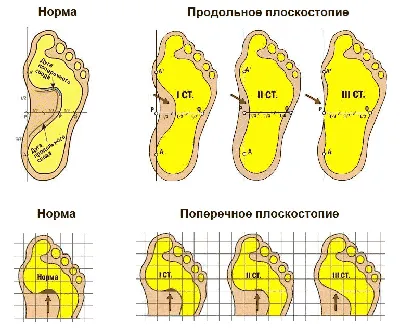 Врожденная деформация стоп – tdstandart