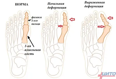 5 причин деформации стоп – tdstandart