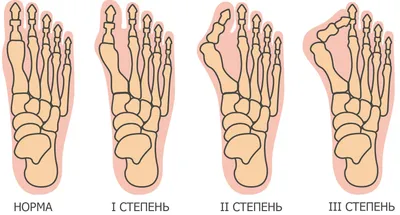 Вальгусная деформация стопы - БСМП Гродно