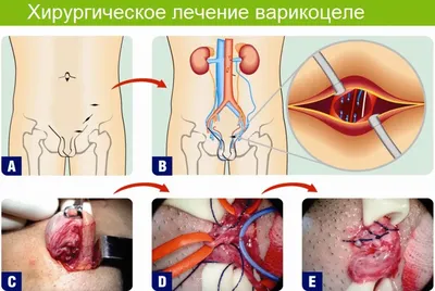 Варикоцеле (варикоз яичек) лечение в Украине | Клиника Биляка