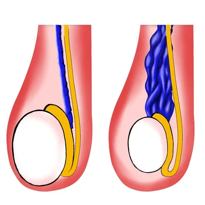 Варикоцеле: симптомы, причины, лечение, последствия, признаки и последствия  заболевания