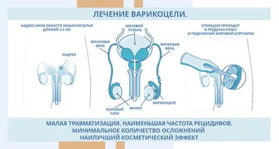 Варикоцеле: причины, симптомы и лечение в Клинике АльтраВита