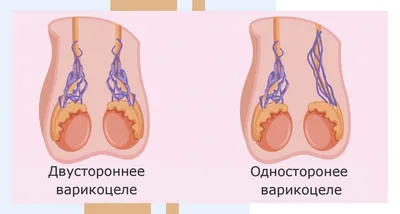 Варикоцеле: причины, симптомы и лечение в Клинике АльтраВита