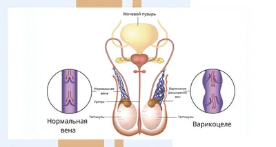 Влияет ли варикоцеле на бесплодие - какая связь?