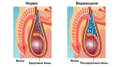 Варикоцеле у мужчин: лечение, степени, симптомы и причины