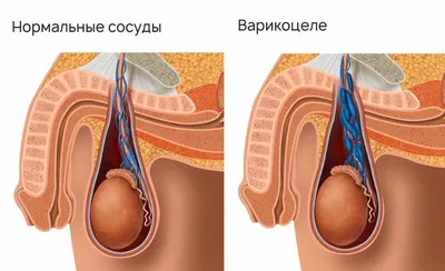 Варикоцеле: причины, симптомы и лечение - Medpark