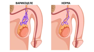 Что делать при варикоцеле? Нужно ли оперировать? ⋮ Медицинский центр  MEDICAL PLAZA