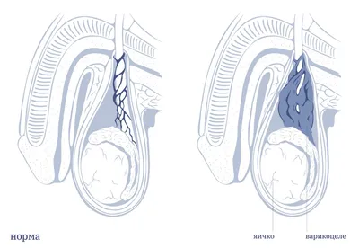Варикоцеле | ТС Клиника — г. Краснодар