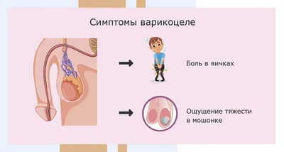 Операция Мармара при варикоцеле у подростков