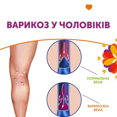 Лечение варикоцеле в клинике «Семейная» - Новости