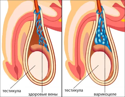 Варикоцеле