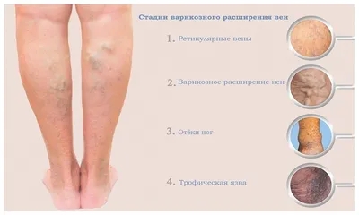 Заболевания вен — симптомы, лечение в Москве!