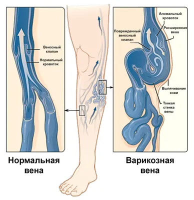 Германская новая медицина, Психосоматика - Варикоз и тромбофлебит вен  нижних конечностей Варикоз (расширение объема) вен на ногах происходит, в  основном, у женщин. Как осложнение, может возникать воспаление стенок вен  (флебит). Воспаленные вены