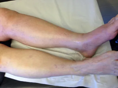 Профилактика варикозного расширения вен на ногахи у женщин | Медицинский  центр ФлебоПлюс