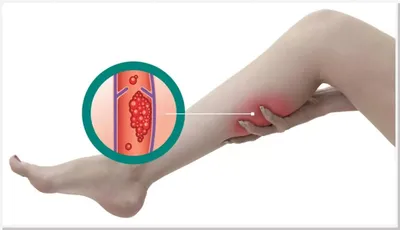 Тромбоз глубоких вен - Центр Флебологии РАН