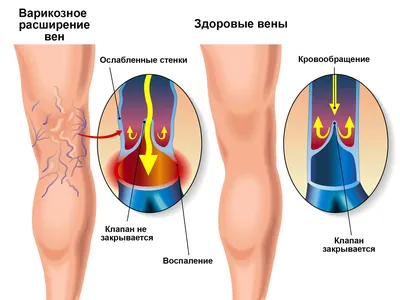 Тромбофлебит: симптомы, причины, классификация, осложнения, что делать,  профилактика