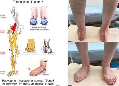 Ретикулярный варикоз нижних конечностей: признаки, причины и лечение  ретикулярного расширения вен