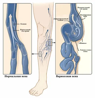 Варикозное расширение вен: причины, симптомы, диагностика, лечение