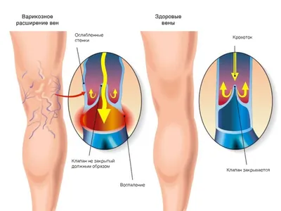 Ретикулярный варикоз вен нижних конечностей - лечение в медицинском центре  ФлебоПлюс