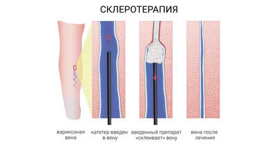 Как лечить сосудистые звёздочки - «Институт Вен» лечение варикоза в Киеве и  Харькове