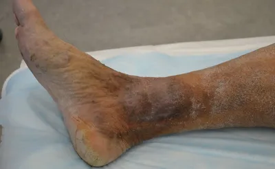 Варикозный дерматит на ногах фото фотографии