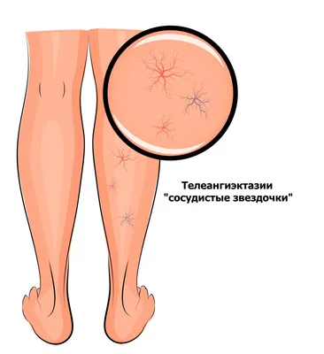 Венозный дерматит (8 фото): причины, симптомы, лечение, профилактика –  Лостерин