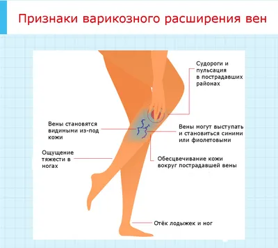 Варикозное расширение вен, диагностика и лечение в медцентре