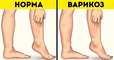 Варикозный дерматит — симптомы, причины, диагностика и лечение венозных язв