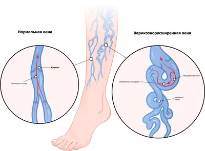 Чешутся вены на ногах | Зуд ног при варикозе ᐉ Flebolog.ua
