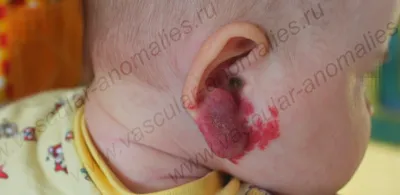 Московские хирурги сняли маску с ребенка с гигантской губой - МК