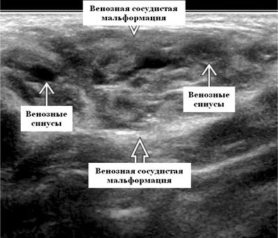 Современное лечение детей с экстракраниальными венозными мальформациями  головы и шеи | РОИСА