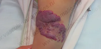 Лазерное лечение венозной мальформации на лице в клинике «Delete» - клиника  лазерной косметологии в Москве