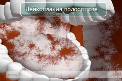 Лечение лейкоплакии полости рта