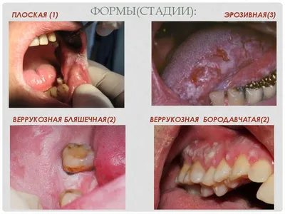 ПРЕДРАКОВЫЕ ЗАБОЛЕВАНИЯ СЛИЗИСТОЙ ОБОЛОЧКИ ПОЛОСТИ РТА И КРАСНОЙ КАЙ