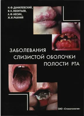 Клинический разбор случаев проявления красного плоского лишая в полости рта  - Клинический разбор в общей медицине №06 2021 - CON-MED.RU