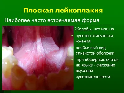 Лейкоплакия – причины, симптомы и лечение заболевания