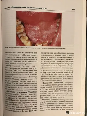 Доброкачественные опухоли полости рта: что провоцирует, виды, лечение