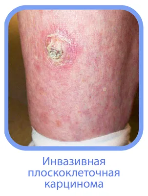pre-cancer diseases of red lip border and oral mucosa