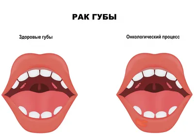 Лейкоплакия. Лекция для студентов 5 курса - online presentation