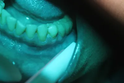 ВИЧ-инфекция: проявления в области рта при СПИДеDENTALMAGAZINE.RU