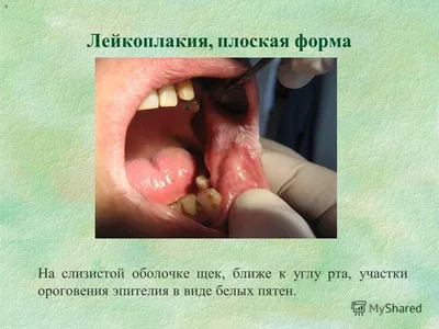 Альвеолит после удаления зуба: фото, лечение, сухая лунка | Dental Art