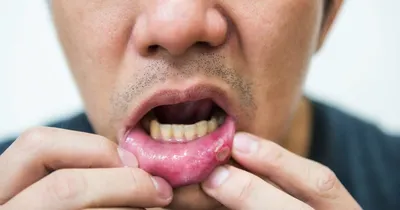 Лейкоплакия (лкп) - признаки, причины, симптомы, лечение и профилактика -  iDoctor.kz