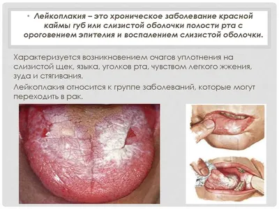 Оценка клинических проявлений лейкоплакии на слизистой оболочке пол