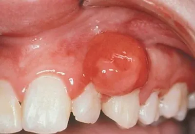 ВИЧ-инфекция: проявления в области рта при СПИДеDENTALMAGAZINE.RU