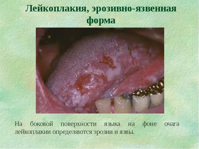 ПРЕДРАКОВЫЕ ПОРАЖЕНИЯ ПОЛОСТИ РТА